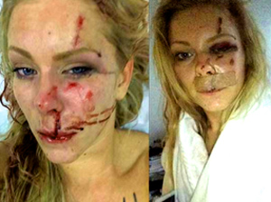 "Apparently, Mads’ decision to respond to the heckler set him off. Nanna says that after Mads spoke, the cyclist got off his bike and jumped on her boyfriend then hitting him on the head with a bottle. At the same time several other black men came up out of a basement area holding iron chains and joined the assault on Mads." - Eagle Rising