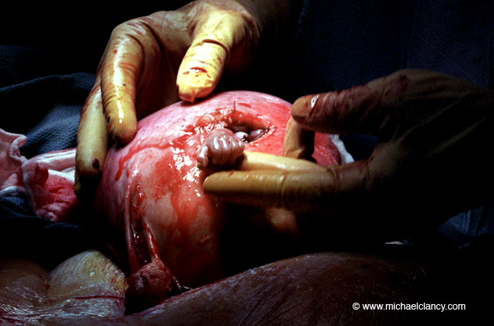 During a spina bifida corrective procedure at twenty-one weeks in utero.  Samuel thrusts his tiny hand out of the surgical opening of his mother's uterus.  As the mother lifts his hand, Samuel reacts to the touch and squeezes the doctor's finger. - Michael Clancy, photographer.