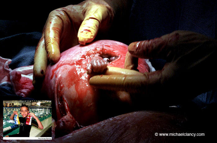 Michael Clancy's famous photo with its fetus now over ten-years old in the person of Samual Armes, a happy young American boy enjoying the world he was allowed to be born into.   